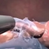 阑尾切除术手术过程，3D演示。。