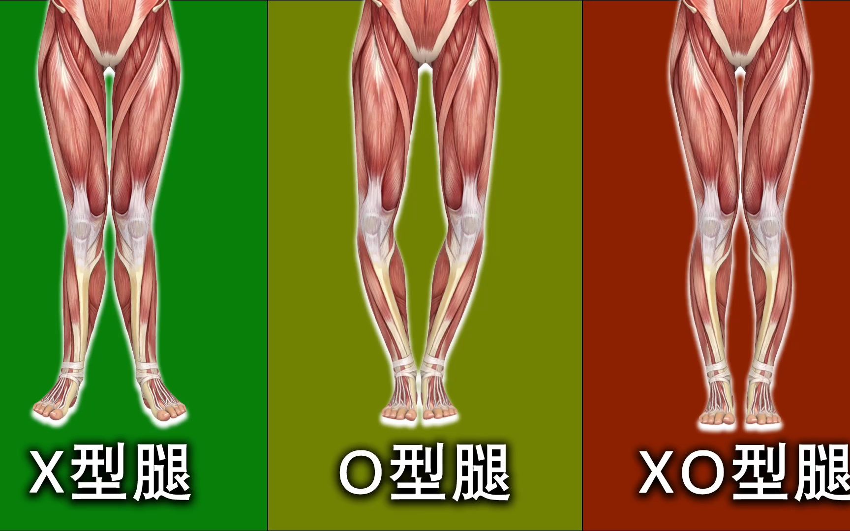 X/O/XO型腿矫正合集，腿型矫正必看