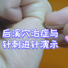 后溪穴治症分享与针刺进针演示