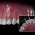 隐形牙套是怎么让牙齿排齐的？薄薄的透明牙套到底有多神奇能移动牙齿呢？