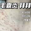 亲身治疗马拉色菌毛囊炎｜毛囊炎辨别&超详细治疗攻略