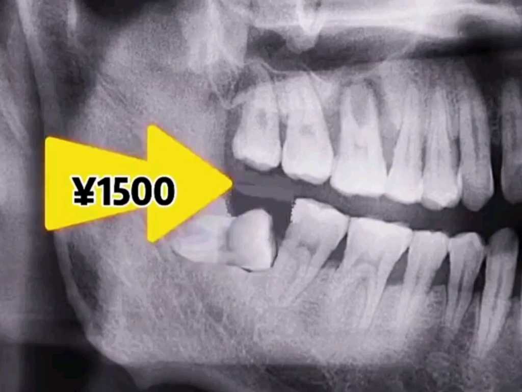 不同位置拔智齿的价格！看看你的智齿值多少钱？