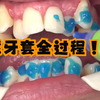 牙齿矫正戴牙套全过程