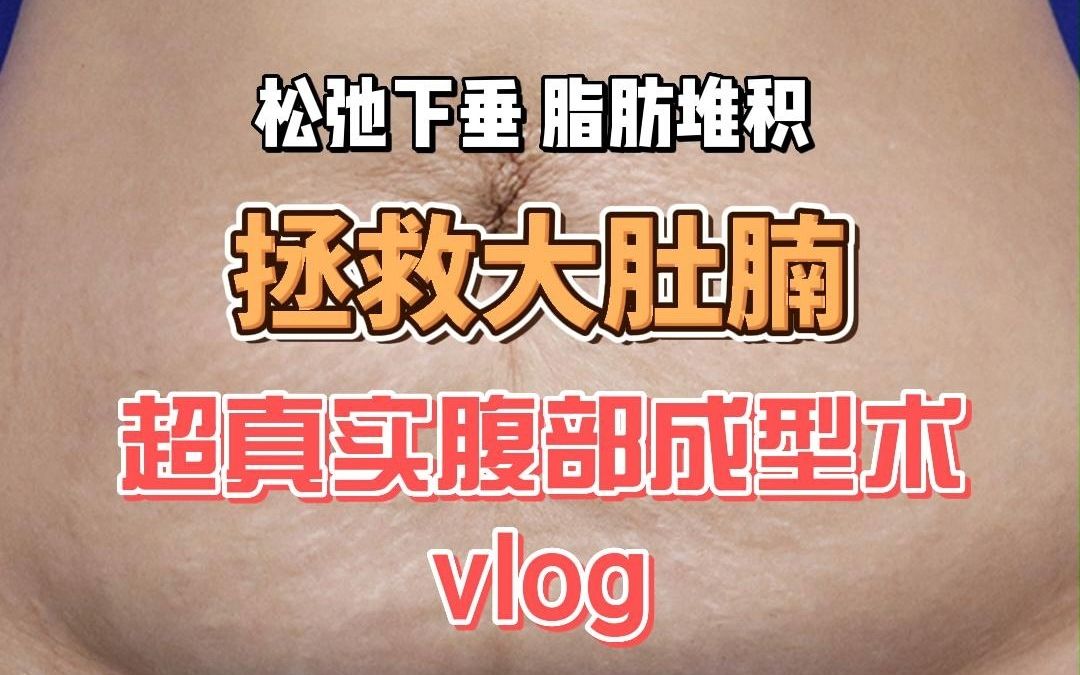 超真实腹壁成型术vlog，生产后大肚腩皮肤松弛下垂，减肥锻炼也不管用，这次下定决心来手术了