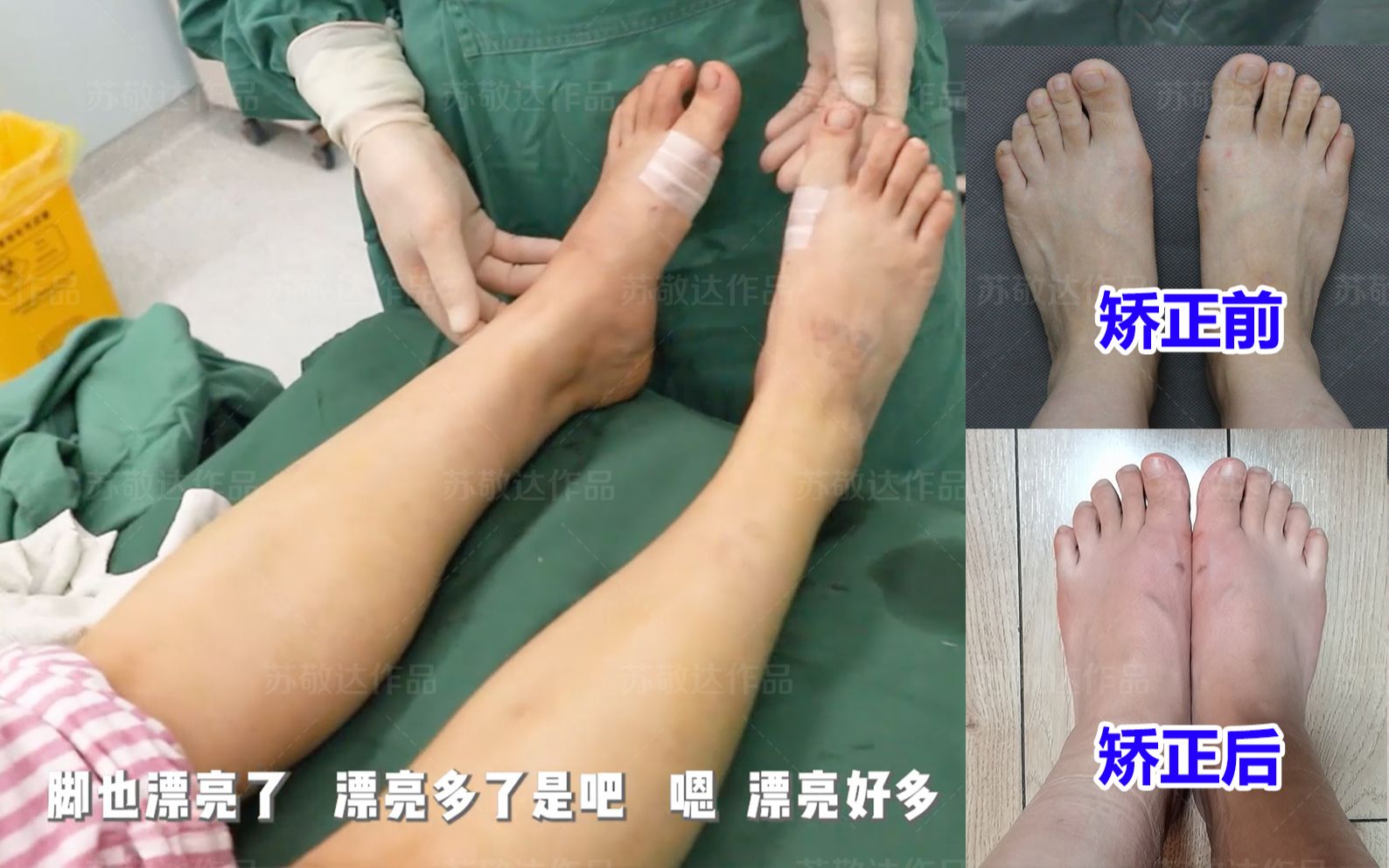 大脚骨医生苏敬达北京来的女士脚窄了好看了恢复跑10公里也没问题