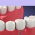 种植牙的过程是怎样的