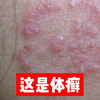 身上长环状红斑，可别误以为是湿疹，医生教你如何正确处理