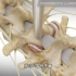 腰椎椎管狭窄的手术治疗过程，3D演示。。