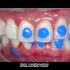 牙科医院|牙齿正畸矫正全过程