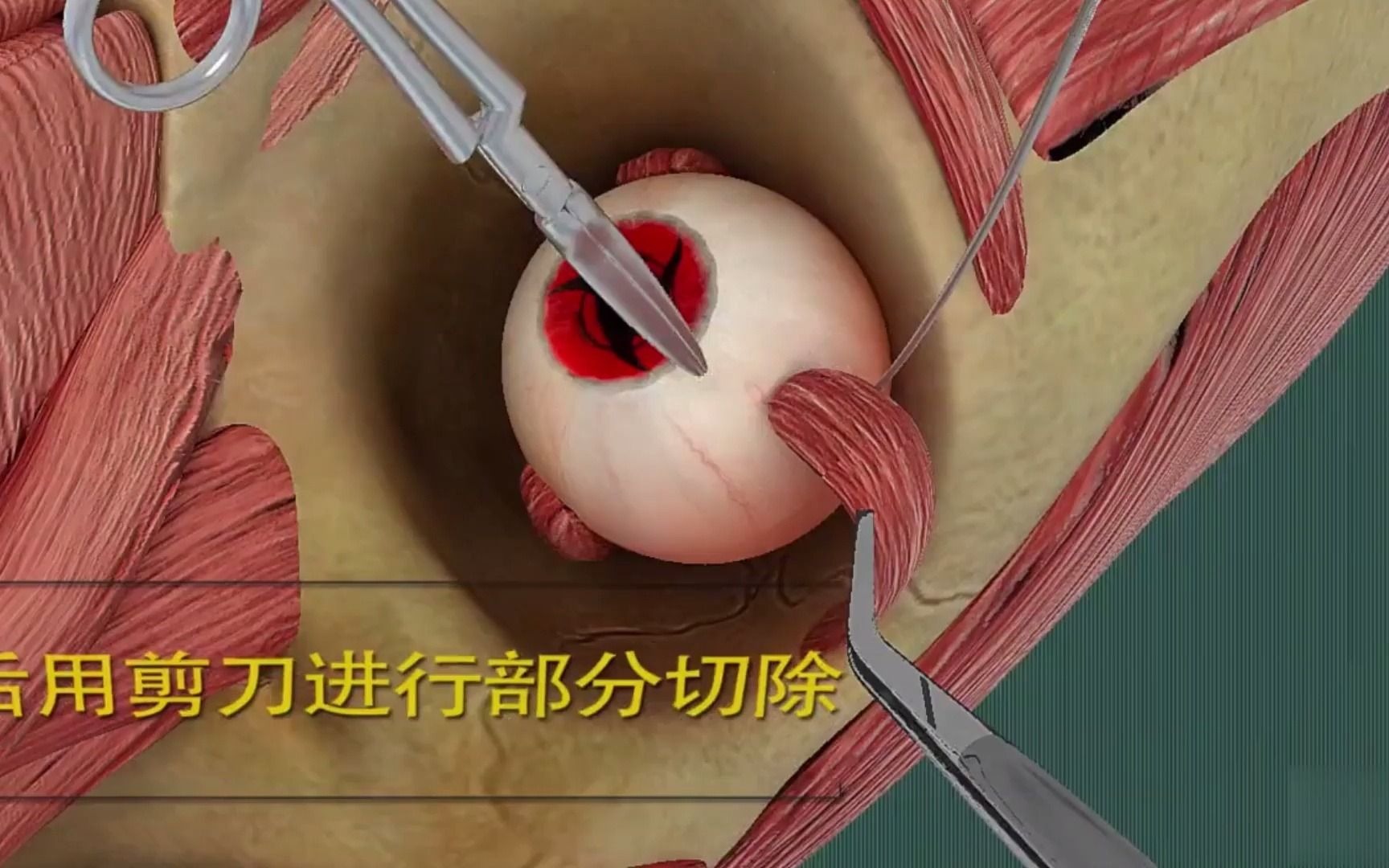 3D医学视频：眼睛斜视是怎么矫正的，快来看看吧！
