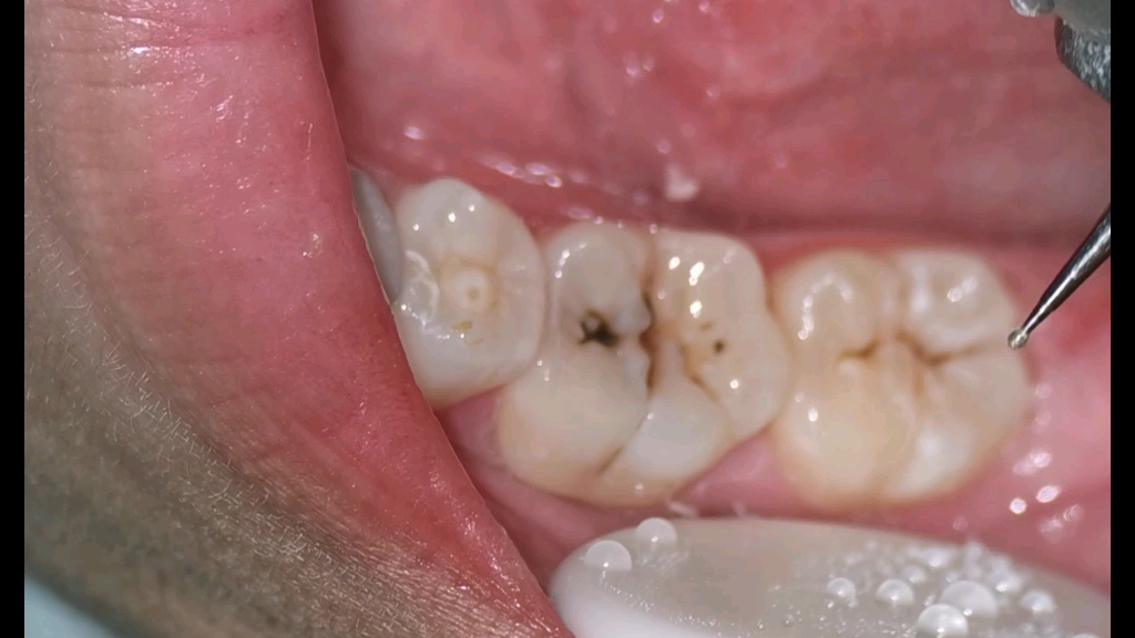 小姑娘蛀牙的树脂补牙过程