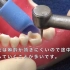 【根管治疗】根管治疗的全过程！清晰完整的看你的牙齿是怎么被掏空的