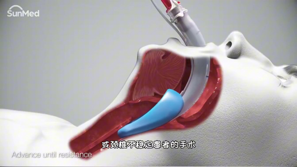 喉罩是什么，与气管插管和气管切开区别，3D演示。。