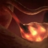 试管流程-IVF-ET胚胎移植
