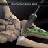 桡骨骨折手术固定过程，3D演示。。