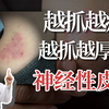 【科普】睡不着越抓越痒，越痒越想抓...试试这样处理