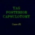 【两例YAG激光晶状体后囊切开术治疗后发障】YAG Laser Posterior Capsulotomy