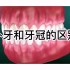 【深圳补牙科普】补牙和牙冠的差别是什么？！补牙和牙冠过程