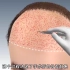 植发手术过程，3D演示。。