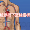 开胸手术，心脏停搏下冠脉搭桥过程动画演示