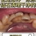 【深圳洗牙】牙医是怎样一点点将牙结石清理干净的呢？