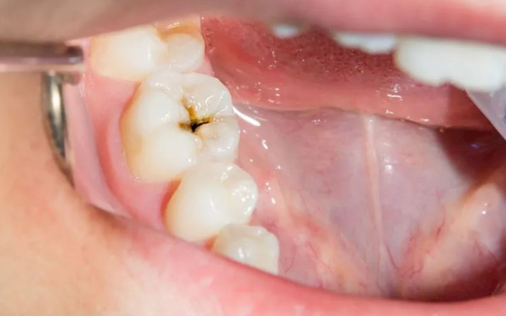 牙齿上有小黑点，就要掏一个洞？牙医到底想干嘛