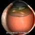 视网膜脱离原因，不手术会失明，3D演示。。
