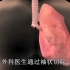 3d医学动画：肺癌的几种治疗方法