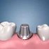 三维小短片带你了解种植牙全过程+医疗三维动画