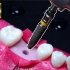 牙科种植3D流程（种植牙流程/种牙可怕吗？）