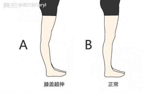 矫正膝盖超伸还你漂亮的小腿