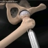 大腿股骨颈骨折手术修复过程，3D演示。。