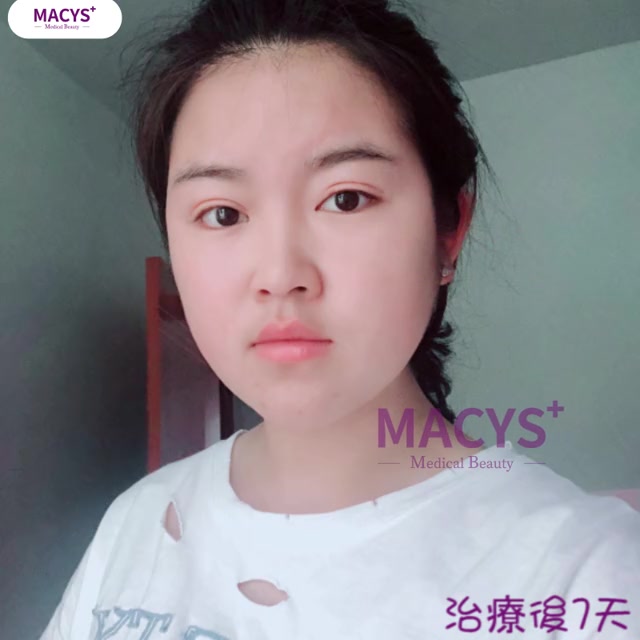 Macys定位无痕私人定制双眼皮哔哩哔哩bilibili