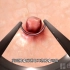 膀胱镜下膀胱肿瘤切除手术，3D演示。。