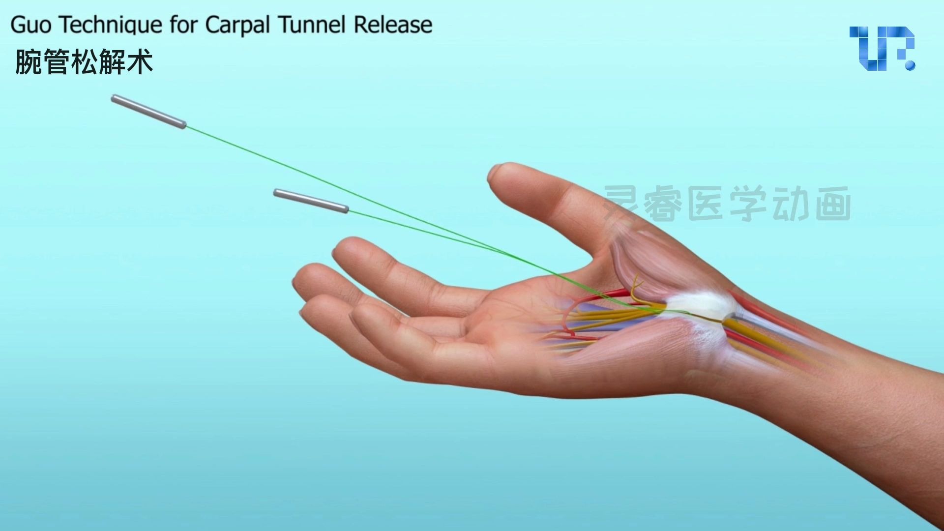 3D动画演示腕管松解术-治疗腕管综合征