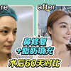 【鼻修复60天对比】耳软骨+膨体鼻综合修复，外加全面部脂肪填充