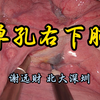单孔胸腔镜右肺下叶癌根治术（解说版）直播回放1.5倍速 谢远财教授（北京大学深圳医院