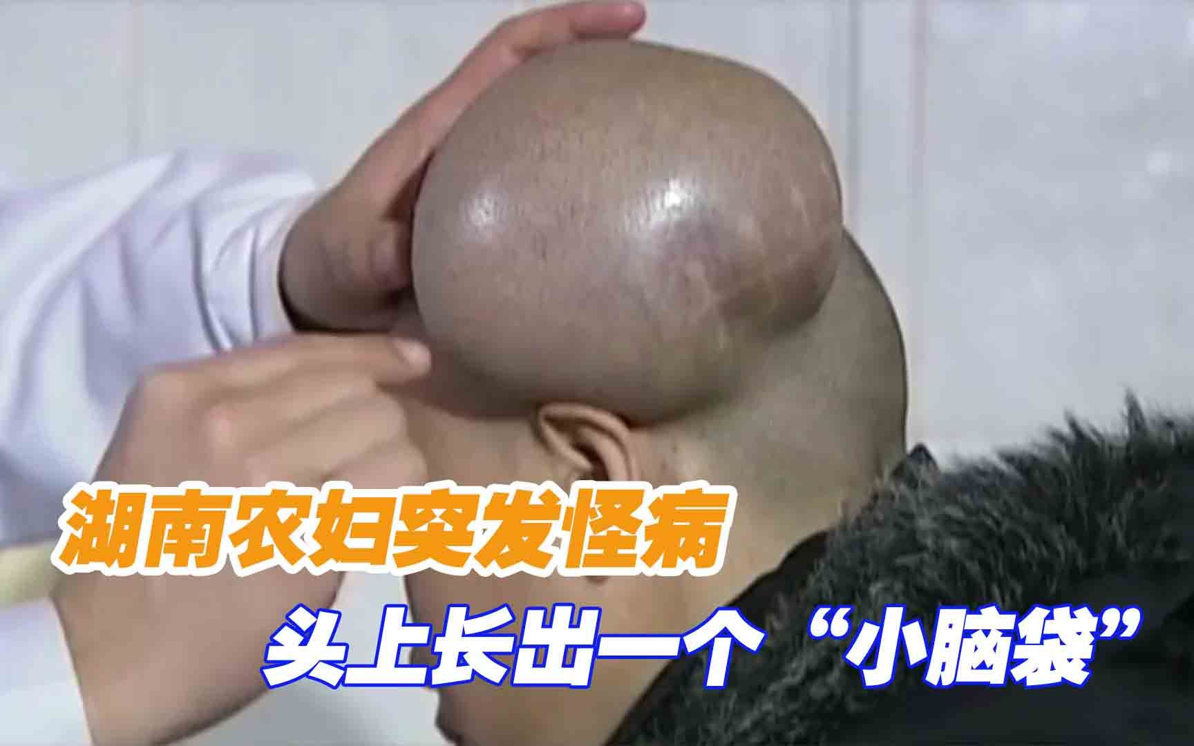 湖南农妇突发怪病，头上长出一个“小脑袋”，几家医院都不敢收
