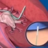 3D视频演示：肾结石 是如何形成的？