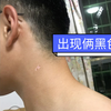 我是如何治愈白癜风的