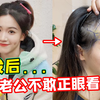 熬夜吗？脱发吗？沉浸式植发体验下！每一根毛都在颤栗