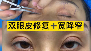 <em class="keyword">双眼皮宽修窄修复</em>案例前后对比。