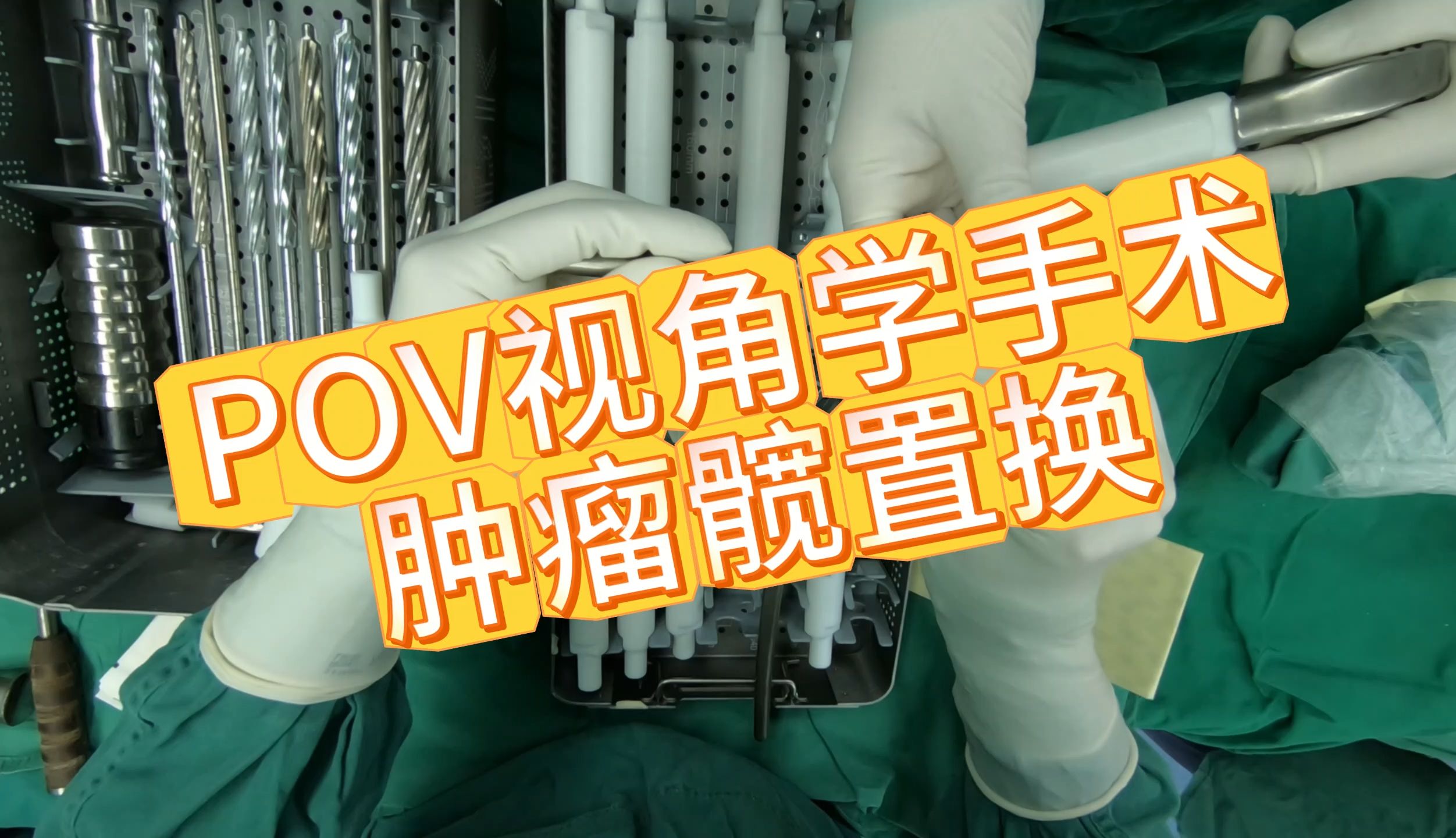 【POV视角】股骨近端肿瘤切除+组配型关节置换手术