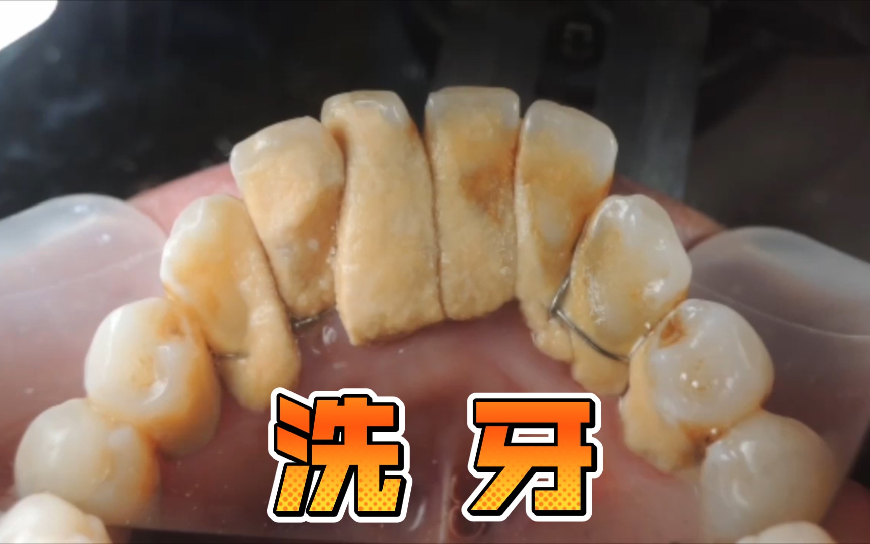 牙结石有什么危害？ - 知乎