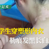 女大学生穿塑形内衣，勒痕发黑长白斑，扩散速度非常快！#白癜风