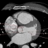 8.心血管影像解剖图谱-心脏瓣膜CT解剖
