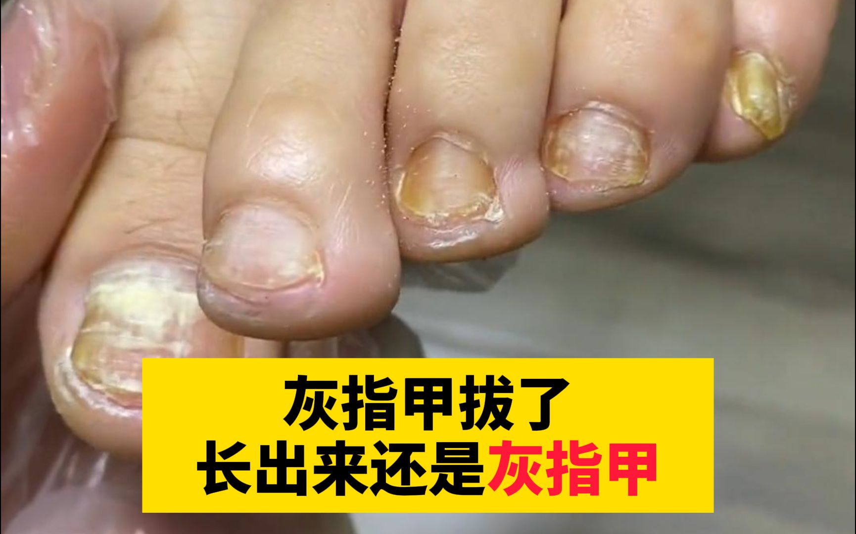 【科普】得了灰指甲一定要及时治疗，这个病是真菌感染引起的，越拖越严重！