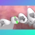 牙齿歪斜如何通过金属牙套矫正呢？