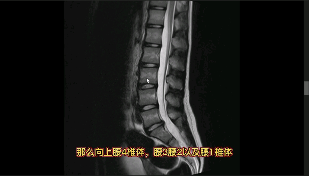 腰椎间盘突出MRI动态图像讲解，零基础也会看，5分钟学会