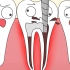 牙根管治疗